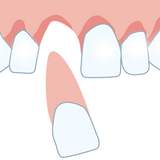 Zahn ausgeschlagen