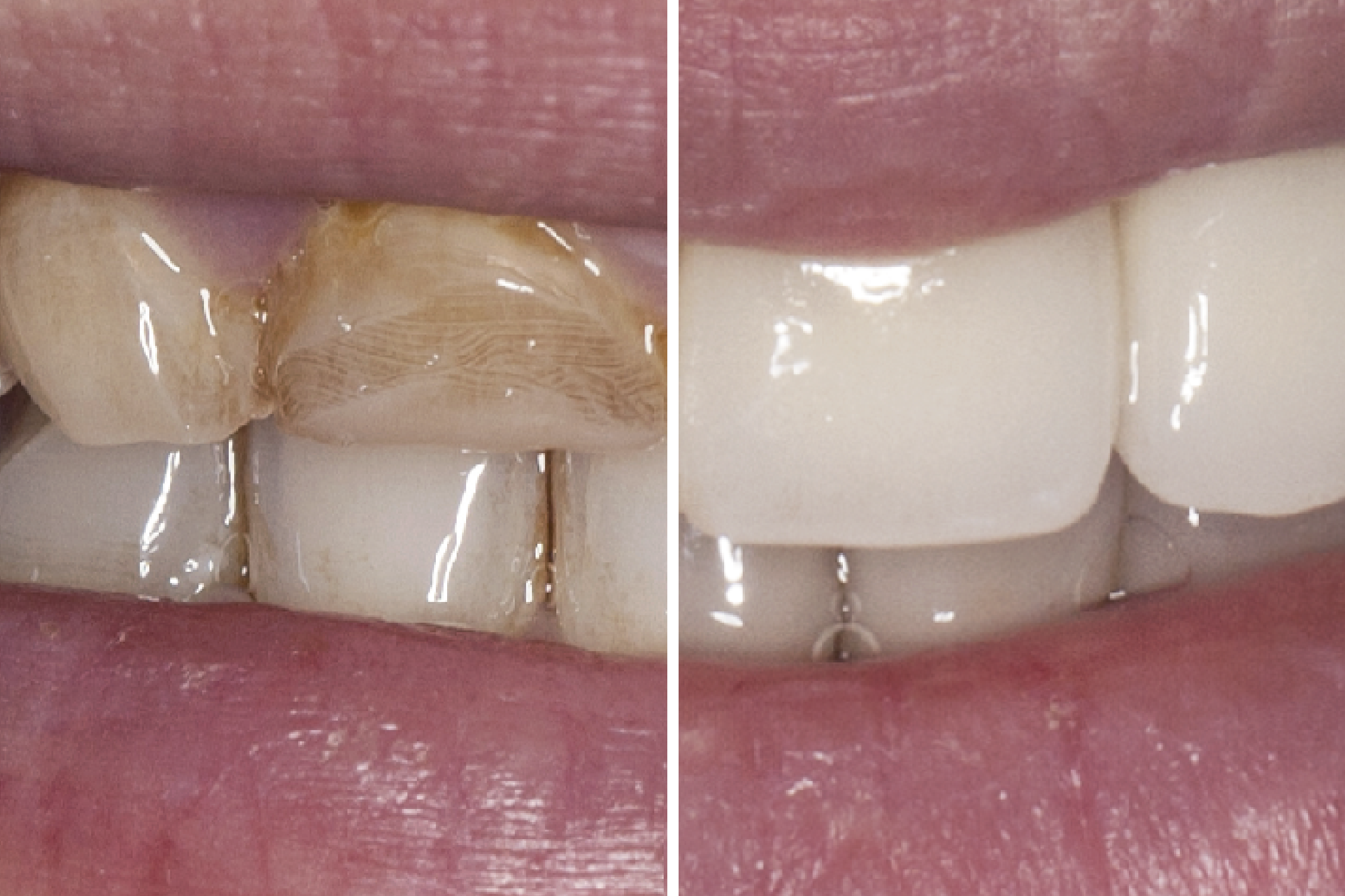 Erfolgreiche Behandlung von Zahnschäden