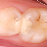 Zahn mit Glasionomerzementfüllung