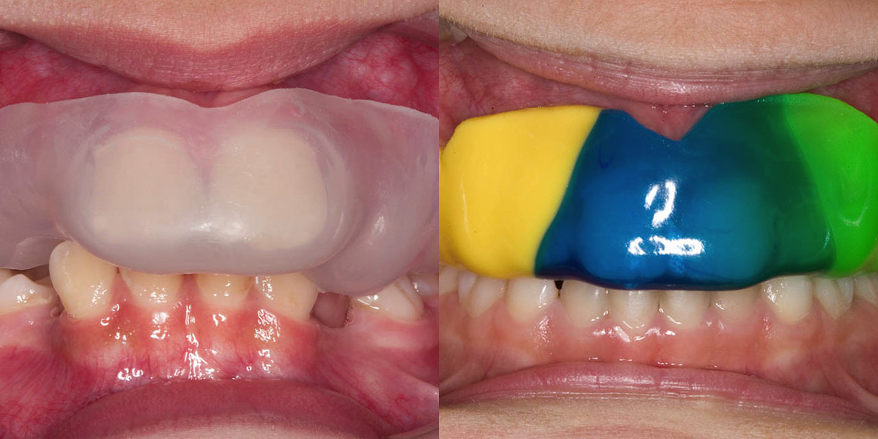 Two examples for an individual mouth guard, one transparent, the other colourful